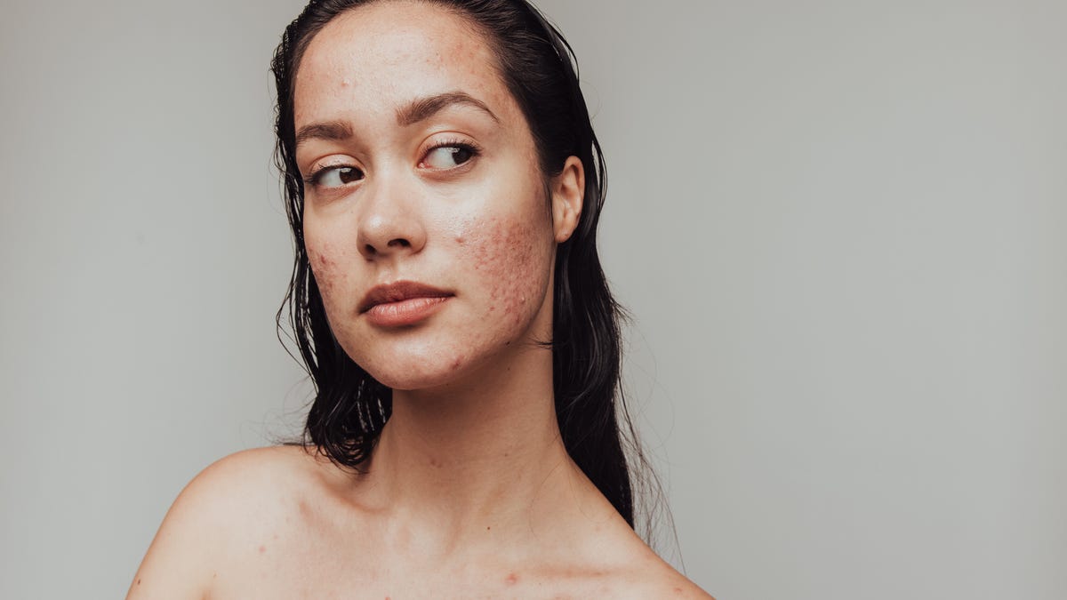 Close up on a woman with acne