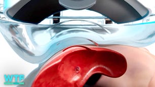 250926-clean-histotripsy-wtfuture-destroying-tumors-with-sound-waves-v1