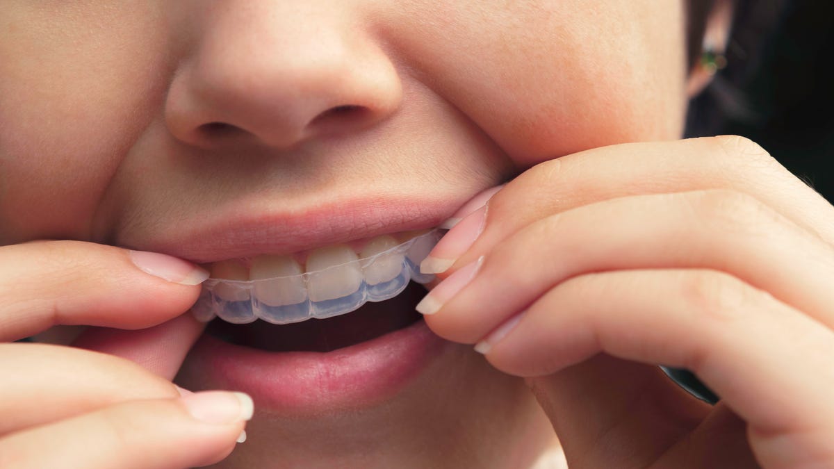 Someone fits clear aligners onto her teeth