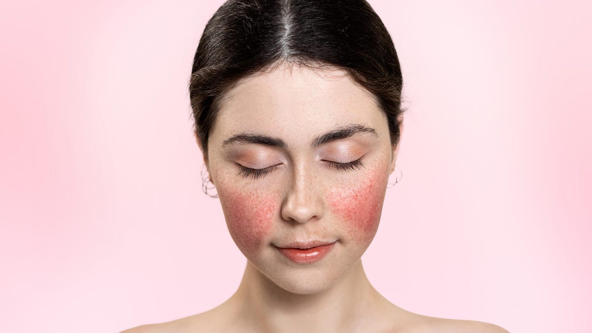 woman with her eyes closed, showing inflamed blood vessels on her cheeks