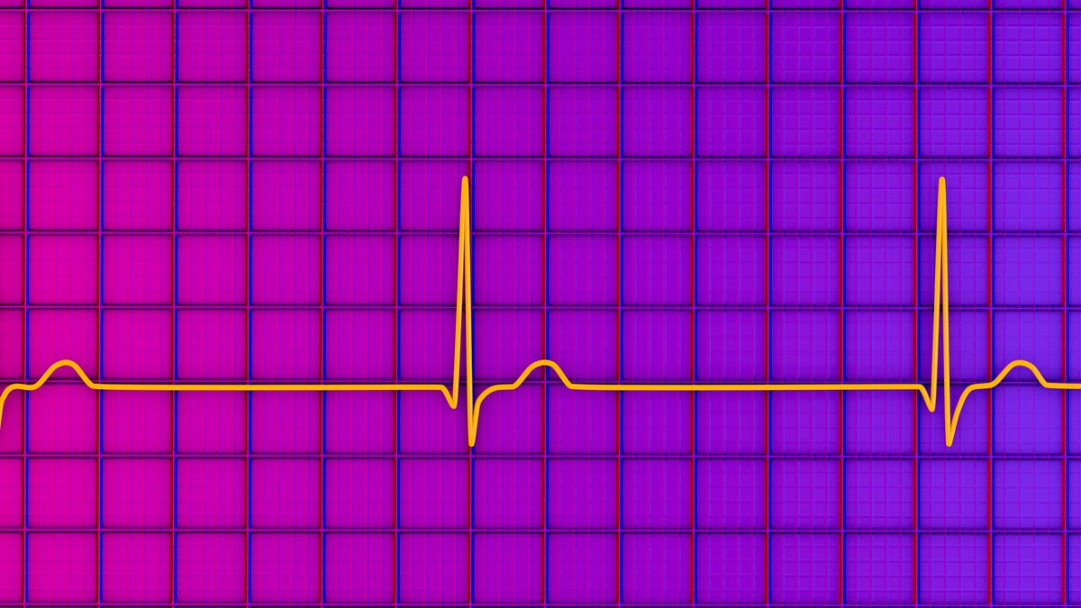 Illustration of junctional rhythm of the heartbeat.