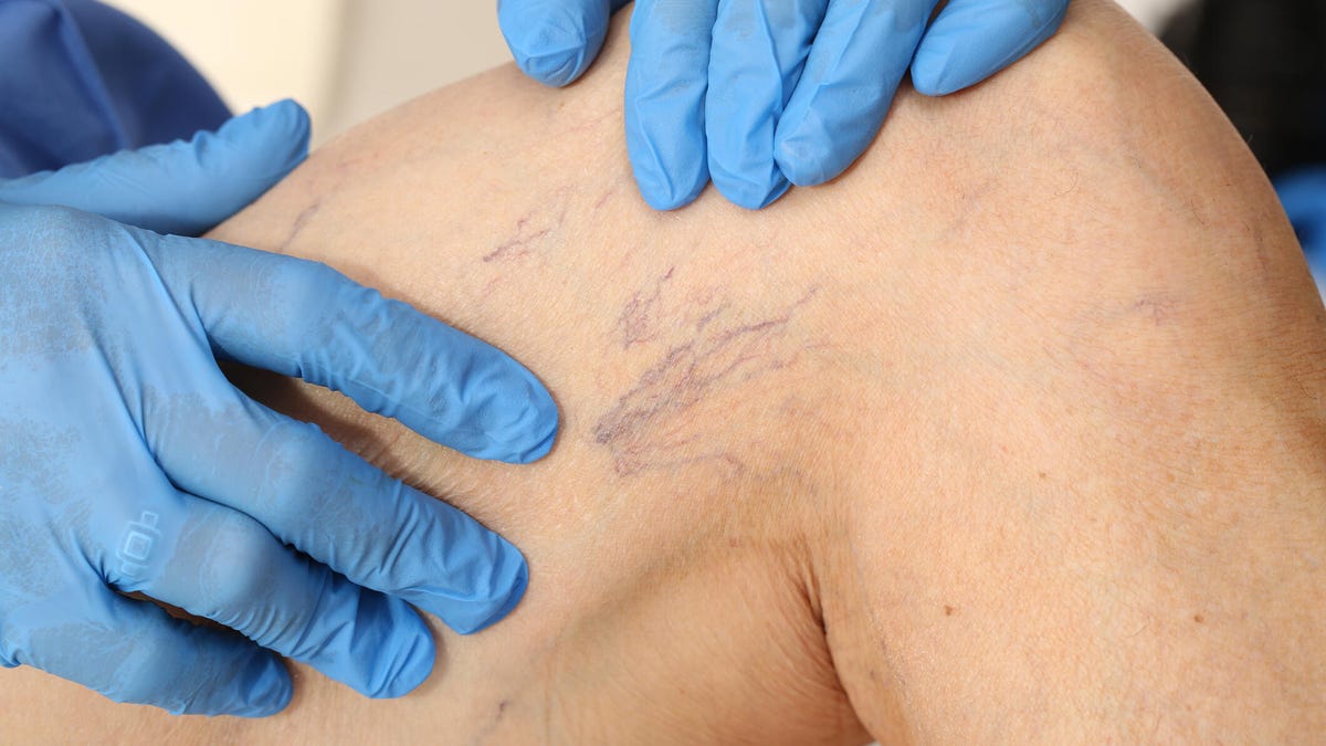 A doctor's blue-gloved hands examining a leg with varicose veins.